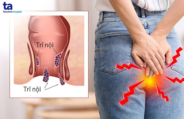 Tìm hiểu nguyên nhân gây nên bệnh trĩ nội