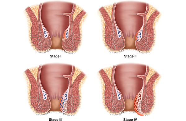 4 cấp độ của bệnh trĩ nội