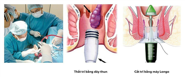 Chữa trĩ nội bằng phương pháp PPH