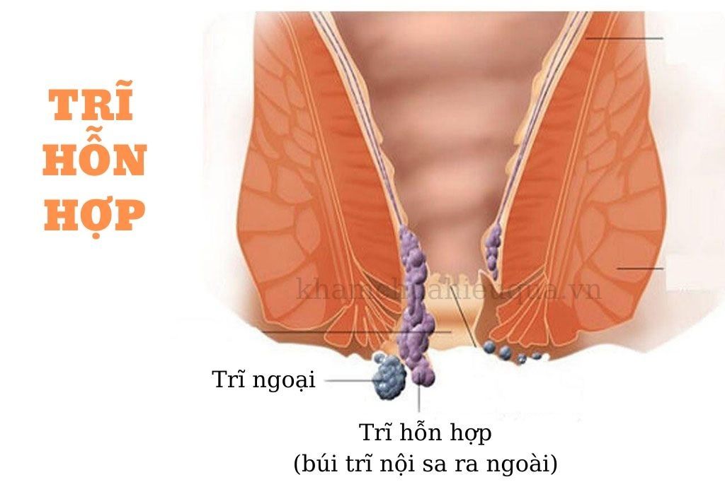 trĩ hỗn hợp